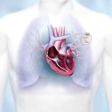 Your heart's natural pacemaker — the sinus node — produces electrical impulses to stimulate your heart to beat. Dx