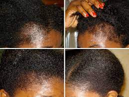 Completely pure emu oil will always be fully refined. Best Organic Emu Oil For Hair Growth
