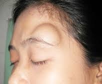 Pin Di Cara Menyembuhkan Lipoma
