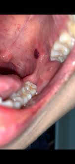What causes blood blister in mouth? Blood Blister In Mouth No Apparent Cause I Can Think Of Noticed It While Eating Lunch Today And Felt Paint In My Mouth It Was Bleeding When I Checked Right After I