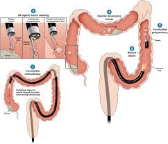 This is also occurs in stage 4.symptoms of colon cancer spread to the lungs include chronic cough, pain in the chest wall, shortness of breath, and fatigue. Can Colonoscopy Sow The Seeds Of Colorectal Cancer Gastroenterology