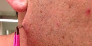 Place it over the ingrown hair for 10 to 15 minutes 6. Watch This Man Pull Out The World S Longest Ingrown Hair And Try Not To Barf Forever