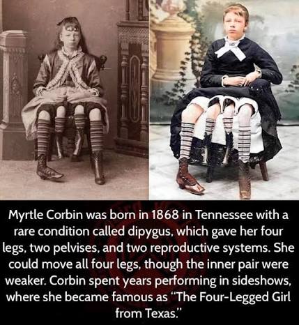 Myrtle Corbin was a young girl born in 1868 in Texas with a rare congenital  condition known as dipygus, which resulted in her having four legs. This  condition occurs when twins are