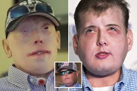 Firefighter who had the world’s most extensive face transplant says he’d  run into the blaze again five years a