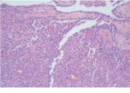 Figure 3 From Pathology Of Mesothelioma Semantic Scholar