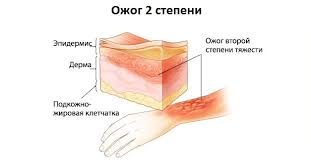 Pervaya Pomosh Pri Ozhoge Chto Delat Esli Obzhogsya Medicina Medicina I Zdorove Medblog Yandeks Dzen