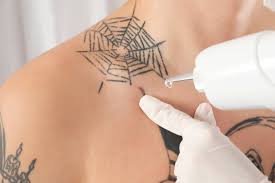 We'll go over the healing. Laser Tattoo Removal Aftercare Tips How To Heal Faster