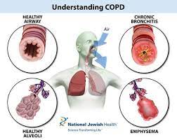 Maybe you would like to learn more about one of these? Test Quiz Pharmacotherapy Of Copd Proprofs Quiz