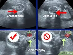 Gambar yang dihasilkan saat pemeriksaan ultrasound 3d umumnya diambil pada berbagai sudut dan kemudian disatukan untuk membentuk rendering tiga dimensi. Cara Membaca Foto Usg 8 Langkah Dengan Gambar Wikihow