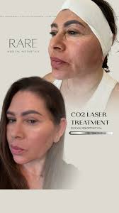 ✨ 𝐖𝐚𝐭𝐜𝐡 𝐌𝐲 𝐏𝐨𝐫𝐞𝐬 𝐃𝐢𝐬𝐚𝐩𝐩𝐞𝐚𝐫! ✨, This is what REAL skin  transformation looks like after a 𝐂𝐎𝟐 𝐋𝐚𝐬𝐞𝐫 𝐑𝐞𝐬𝐮𝐫𝐟𝐚𝐜𝐢𝐧𝐠  session at 𝐑𝐀𝐑𝐄 𝐌𝐞𝐝𝐢𝐜𝐚𝐥 𝐀𝐞𝐬𝐭𝐡𝐞𝐭𝐢𝐜𝐬 in Ashburn, VA 💥,  Follow along as our gorgeous client ...