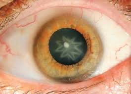 You can perform an easy test to literally see if problems are being developed, a. Cataracts Symptoms And Treatment Live Science