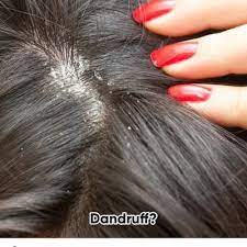 Dry And Flaky Scalp Problems No More Dry Flaky Scalp Flaky Scalp Hair Dandruff