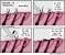 Plucking Pubic Hair Side Effects