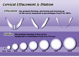 Effacement And Dilation July 2018 Babies Forums What To Expect