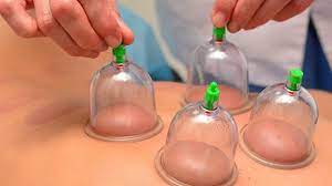 Formation la médecine des ventouses. Connaissez Vous Soins Aux Ventouses Vaudreuil Soulanges Neomedia