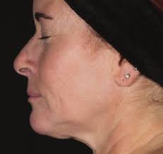 First Ever Four-Mode RF Microneedling Device