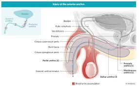 Image result for Genitourinary Trauma