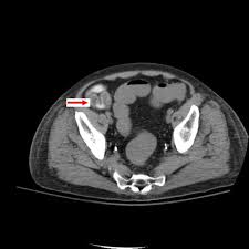 Image result for Neutropenic Colitis