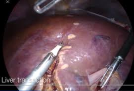 Maybe you would like to learn more about one of these? 4k Lap Central Liver Resection For Hepatic Adenoma Olympus Professional Education On Demand Library