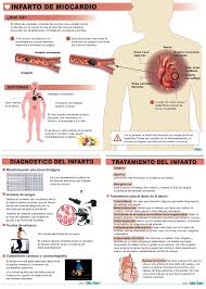 Infarto agudo al miocardio el término infarto agudo de miocardio hace referencia a un riego sanguíneo insuficiente. Infarto Agudo De Miocardio Musculo Cardiaco Se Muere Y El Corazon Se Rompe Salud Ediciones