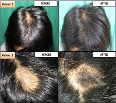 Depending on what's causing your lady locks to thin or fall out, there are a variety of options to help women with hair loss. A Comparative Study Of The Outcomes Of Potent Topical Steroids Versus Topical Tretinoin In Patchy Alopecia Areata Of Scalp Semantic Scholar