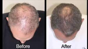 When you are providing a good and healthy environment for which hair to grow well. Efa Complete Nutraceutical Omega 3 6 9 For Optimal Hair Growth Advanced Trichology