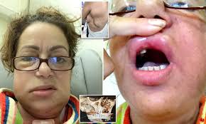 Mouth and throat cancers may look like open sores, growths, or discolored areas in the mouth. Doctors Rebuilt Teacher S Jaw With Her Shoulder Bone After Mouth Cancer Daily Mail Online