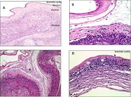 Image result for Chorioamnionitis