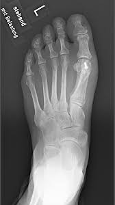 9 seit wann gibt es den hallux valgus? Hv Bilaterale Op Ogam Orthopadie