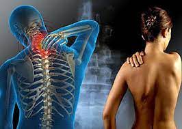 Le torticolis apparaît le plus souvent à la suite d'une. Torticolis Demystification Physio Masso Mp 450 569 4774