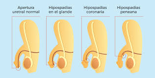 Hipospadias idrar deliğinin normal olması gereken yerden farklı bir yerde, ön tarafta ve daha aşağıda bulunduğu doğumsal bir hastalıktır. Enfermedades Del Pene Hipospadias Clinicas Garcia Reboll