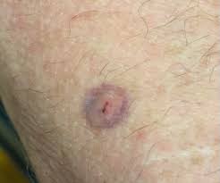 Image result for wolf spider bite skin