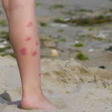 Sand flies are probably the most widespread and definitely one of the most irritating. Sand Flea Bites And Sand Fleas Flea Bites On Humans