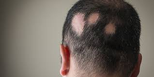 I think the earlier you catch it the better. Itchy Scalp And Hair Loss Causes Treatments And Prevention Tips