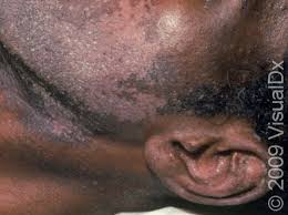 Image result for Beard Dermatitis