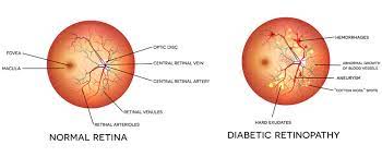 2 кацнельсон л.а., форофонова т.и., бунин а.я. Diabetic Retinopathy Stages Risks Best Treatment In Delhi