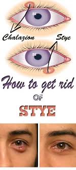 How To Get Rid Of A Stye Get Rid Of Stye Eye Stye Remedies Stye Remedy