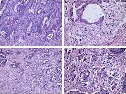 More than 101,400 people will be diagnosed with colon cancer and. Tumor Budding In Colorectal Carcinoma Time To Take Notice Modern Pathology