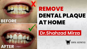 Keep your teeth and mouth healthy with all natural scrubs and cleansing solutions. How To Remove Dental Plaque At Home Dr Shahzad Mirza Dental Aesthetics Youtube