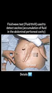 Image result for Shifting Dullness Test