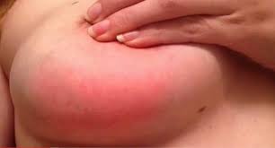 Symptoms typically include local pain and redness. Your Most Common Mastitis Questions Answered Mattos Lactation
