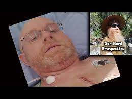 Open Heart Surgery, one week post op