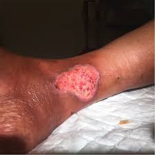It was first identified by the spanish cardiologist fernando martorell in 1945, who referred to the ulcers as 'hypertensive ischaemic ulcers'. A Challenging Diagnosis Of Leg Ulcer
