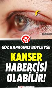 Goz Kapagi Boyleyse Kanser Habercisi Olabilir Akciger Kanseri Bilgi Gozler