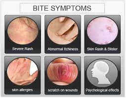 Bed Bug Bite Symptoms What Bedbug Bites Look Like