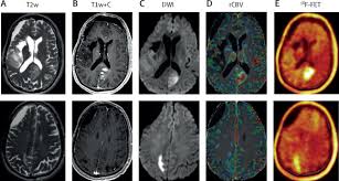 Image result for Primary Tumor Localization
