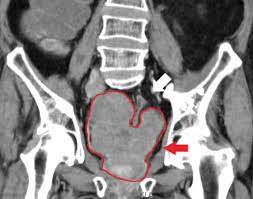Your guide to having a ct scan for mouth cancer. File Ct Of Prostate Cancer Jpg Wikipedia
