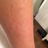 Doing lots of research online has told me that laser hair removal is very effective for folliculitis but ive also found out it can be quite expensive. Https Encrypted Tbn0 Gstatic Com Images Q Tbn And9gcs69ncyttjir1zfqpdt Xjlr50 Mfs3easo9p9y E Usqp Cau