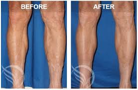 Here in this video i talk about how to get veins to pop out of your arms fast Visible Veins When Should I Worry Vein Specialists Of The South Vein Specialists Of The South