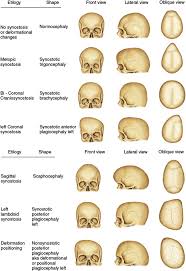 Image result for Positional Head Deformity